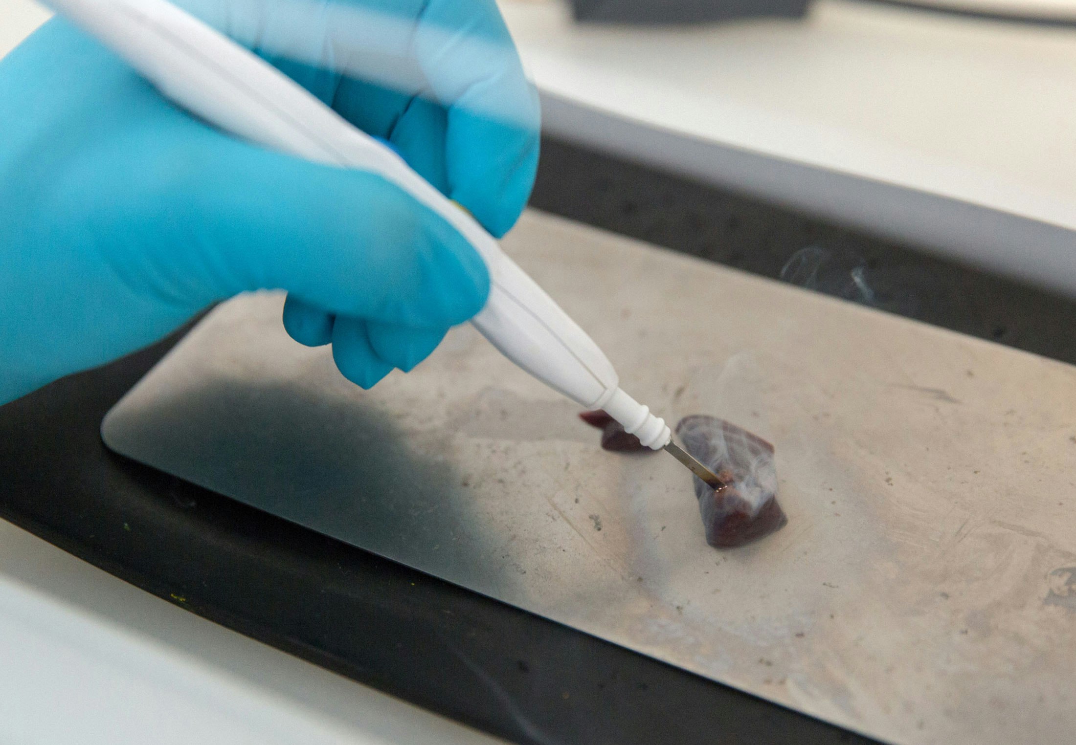 A revolutionary knife that tracks cancer cells in seconds